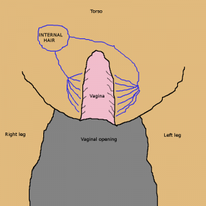 Anterior view of neo-vagina with hair growing inside after genital surgery